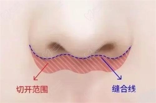 王晓健人中缩短技术怎么样？