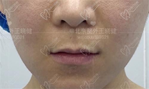 王晓健人中缩短范例二术前图