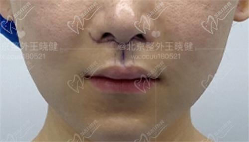 王晓健人中缩短范例二术后即刻