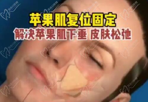 为什么选择蹇洪医生做苹果肌复位提升？