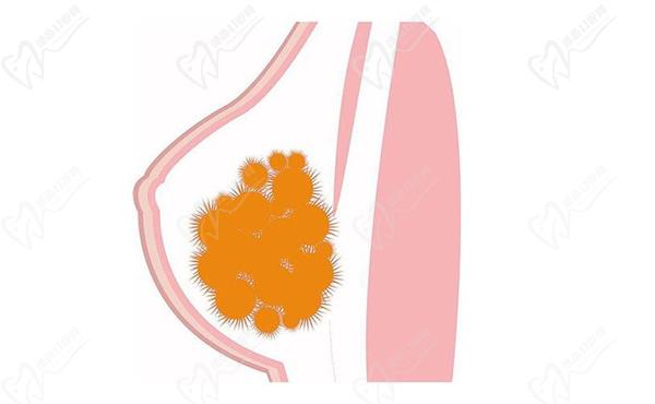 英捷尔法勒就是奥美定注射20年后胸胀疼痛