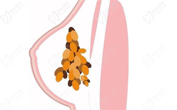 英捷尔法勒就是奥美定注射20年后胸胀疼痛