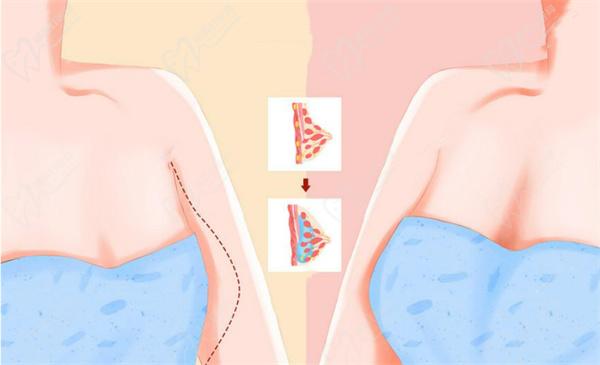 英捷尔法勒就是奥美定注射20年后胸胀疼痛