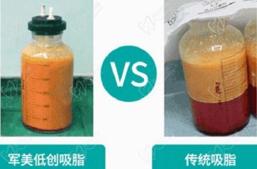 重庆军美整形医院的吸脂项目优势