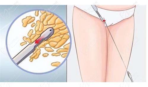 成都恒博天姿李烈吸脂怎么样