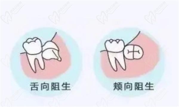 拔智齿