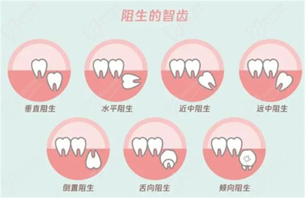 拔智齿