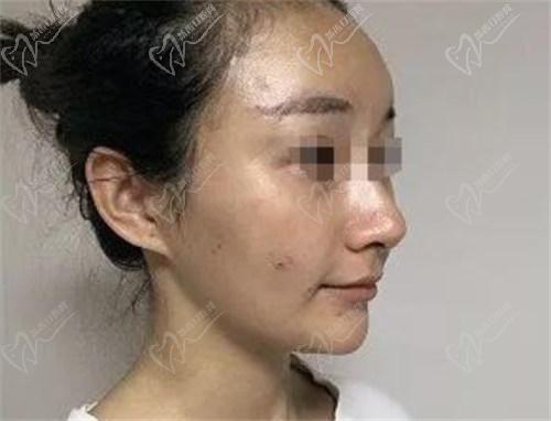 、陈天杰做鼻子的真人实例：