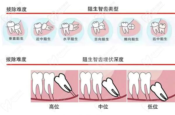 拔智齿