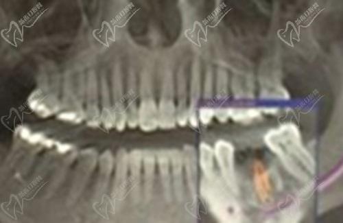 成都极光口腔医院种植牙怎么样？