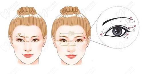 成都悦好陈国双双眼皮