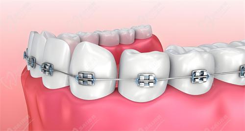 杭州雅莱口腔医院舌侧隐形矫正流程: 杭州雅莱口腔医院舌侧隐形矫正流程: