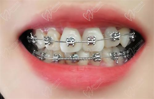 杭州雅莱口腔医院怎么样 杭州雅莱口腔医院怎么样