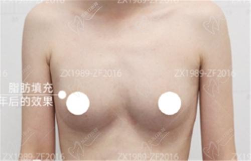 冯斌自体脂肪丰胸术后图