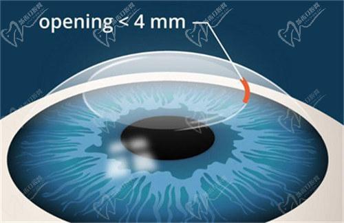 莆田华厦眼科医院眼底病治疗价格表：
