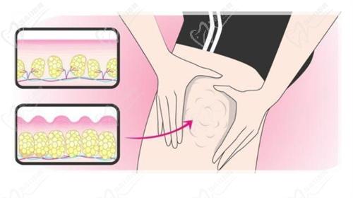 成都王欣吸脂怎么样