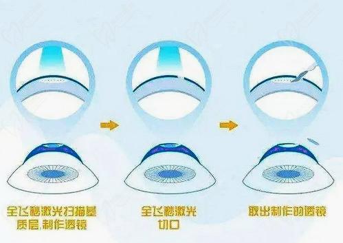 张旭斌院长做全飞秒SMILE 3.0手术技术高超