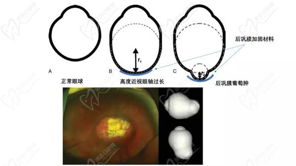 儿童后巩膜加固手术多少钱