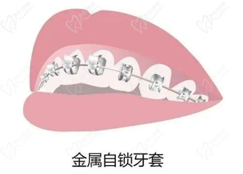 银川诺贝尔口腔医院做牙齿矫正的技术高超