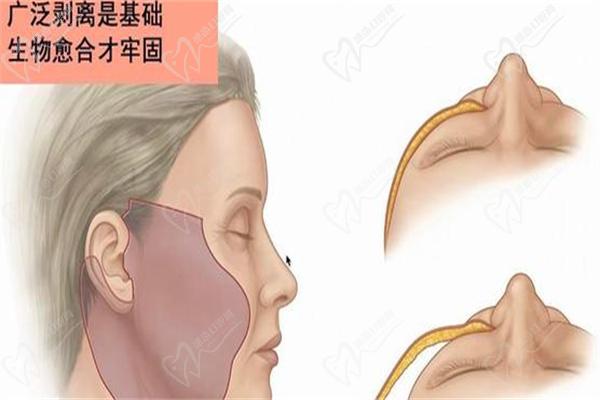 上海颈部大拉皮手术医生排名