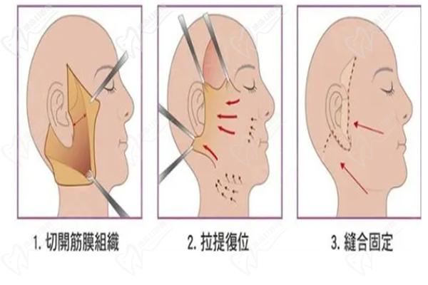 上海拉皮手术预约挂号