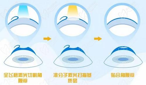 刘磊医生近视手术技术高超