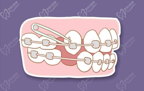 潘牛兵正畸医术怎么样啊