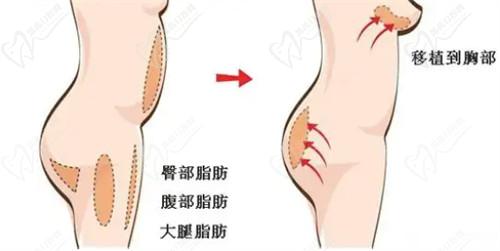 南宁芭芘丽整形医院鼻部整形价格表