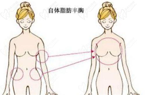 南宁芭芘丽整形医院吸脂价格表