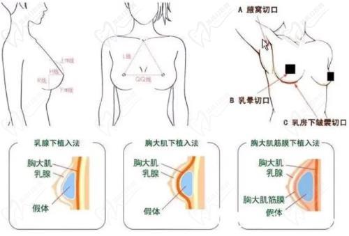 裴旭芳隆胸怎么样