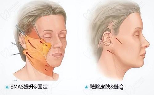 南京华美裴旭芳拉皮除皱如何