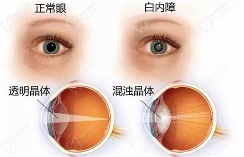 白内障