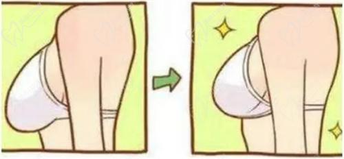 合肥维多利亚何贤清院长缩胸手术优势汇总