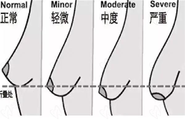  悬垂乳矫正手术