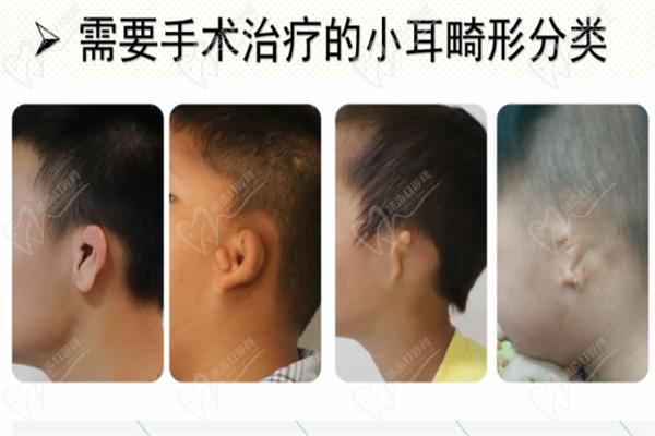 耳再造手术