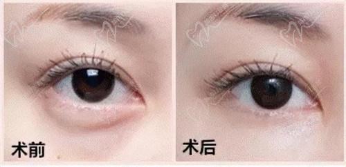祛眼袋手术恢 复期多久