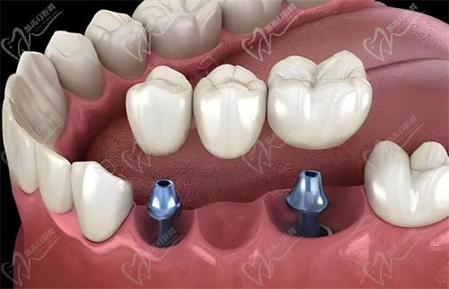 宁波艺星口腔医院怎么样