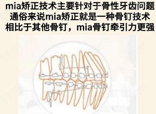 MIA牙齿矫正技术