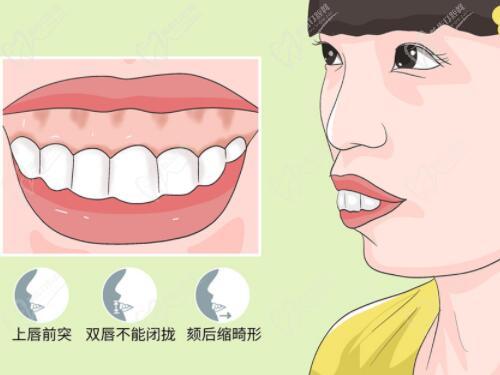 下巴后缩不拔牙矫正混Ⅰ型病例
