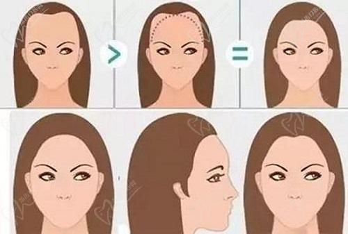 大连大麦微针植发医院张洪霞医生植发口碑评价