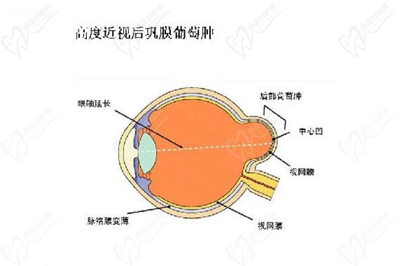 后巩膜加固术