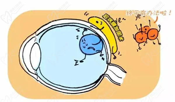 后巩膜加固术