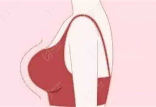 武汉美莱医疗美容汪灏、徐平院长隆胸技术高超