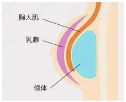 武汉美莱医疗美容维纳斯神V动感无痕丰胸