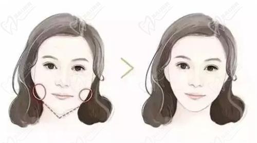 成都八大处颧骨内推要多少钱