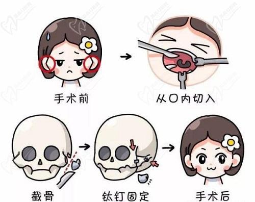 成都八大处颧骨内推优势