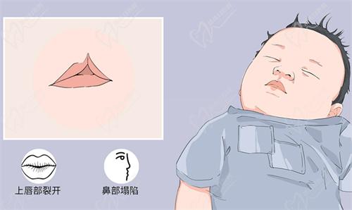 武汉同 济叶子荣医生唇腭裂修复鼻子的技术扎实