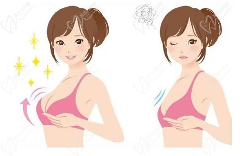 “棉花糖”隆胸