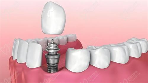 中老年人种牙单颗多少钱 中老年人种牙单颗多少钱