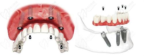 中老年人种牙全口多少钱 中老年人种牙全口多少钱